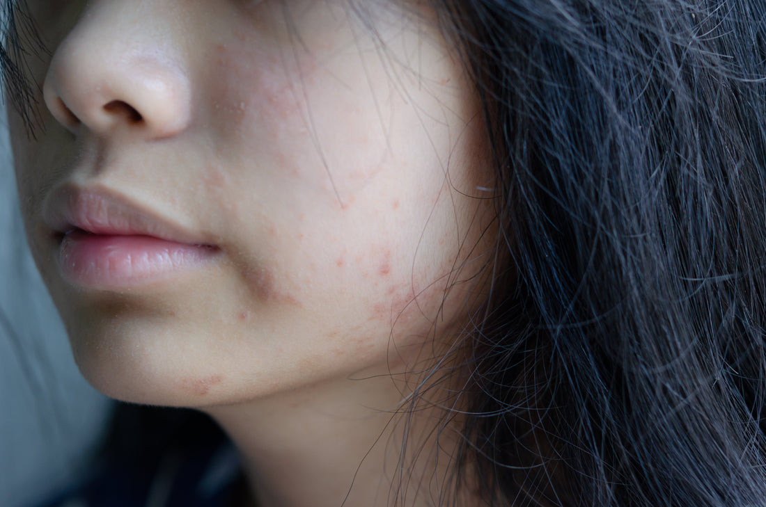 Close up of a dark haired woman with acne issues.